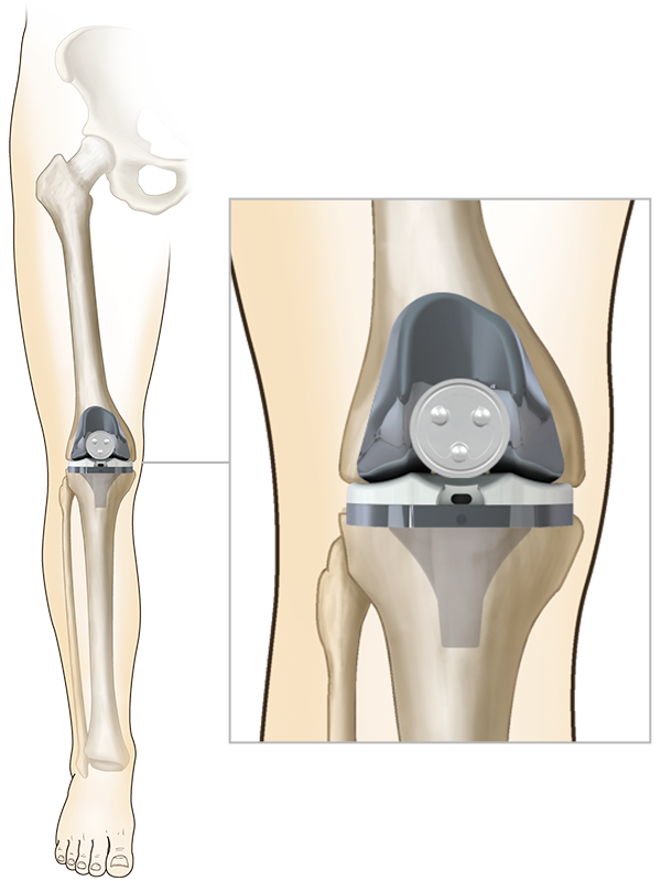 Knee Replacement Pictures 69