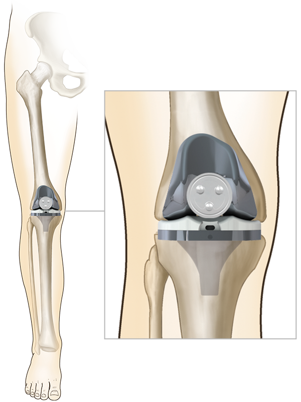Total Knee Replacement