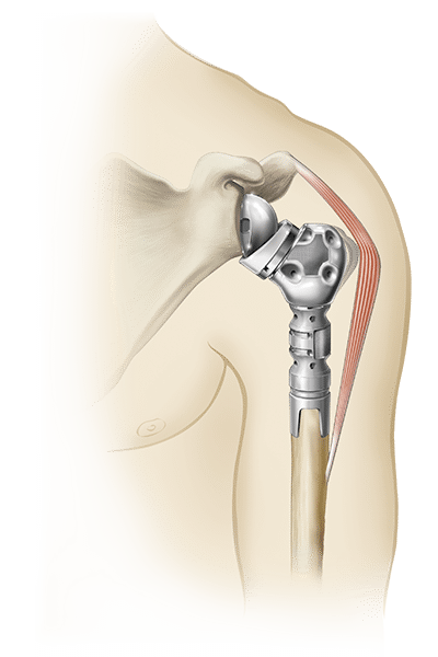 Exactech Equinoxe Shoulder Humeral Reconstruction Prosthesis. Biomechanics, Anatomically shaped proximal bodies restore locations of rotator cuff muscle insertions.