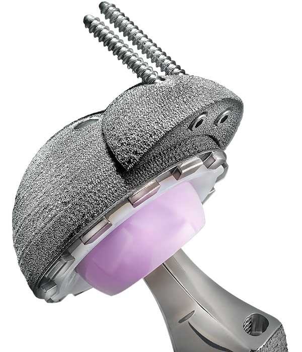 Exactech Hip Revision Acetabular Novation Revision Cup Augment Delta Head
