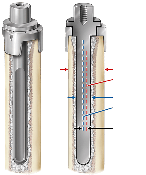 Exactech Equinoxe Shoulder Humeral Reconstruction Prosthesis. Unique plasma/ HA coated collar to provide external fixation and rotational stability.