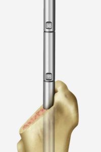 Exactech Hip Revision Femoral Alteon Monobloc Center Rotation Grooves