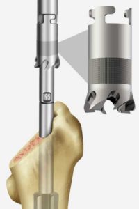 Exactech Hip Revision Femoral Alteon Monobloc Trochanteric Reaming