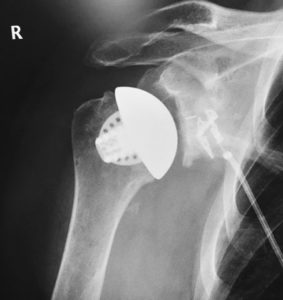 Exactech Equinoxe Shoulder System Stemless Shoulder. Bone conserving prosthesis X-ray of stemless implant.
