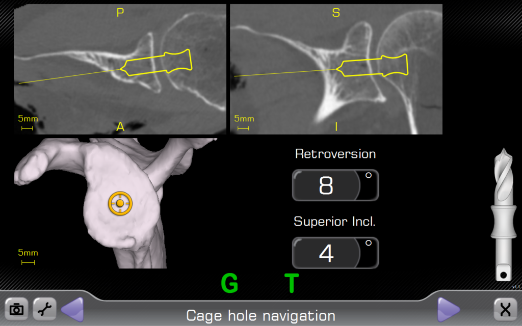 Exactech Real-time navigation with ExactechGPS Shoulder ApplicationReverse Cage Hole Navigation