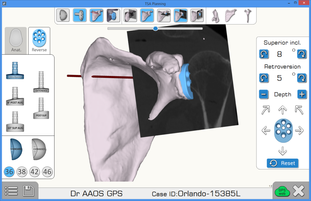 Exactech Equinoxe Shoulder Preoperative planning app with ExactechGPS worrkflow planning software tool