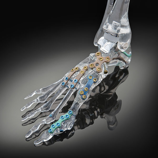 Exactech Vantage Ankle and Epic Foot on Acrylic Foot Model
