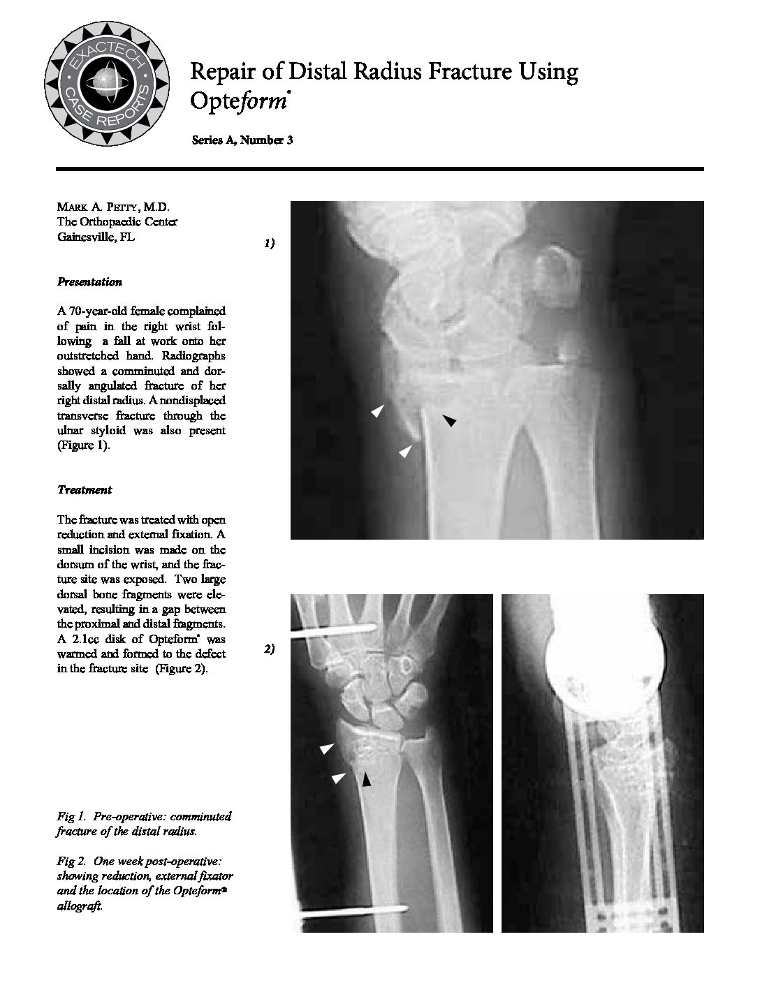Series A, No. 3 Repair of Distal Radius Fracture Using Opteform 713