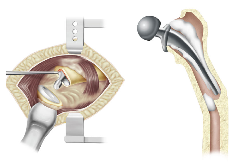 Exactech Brand Standards Medical Illustration