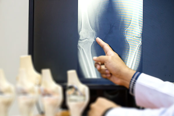 total knee replacement surgery