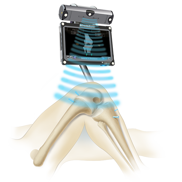 ExactechGPS Knee Application for Knee Replacement Surgery