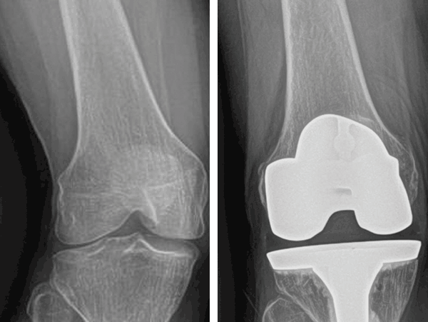 ExactechGPS Knee Application X-rays of a knee replacement surgery