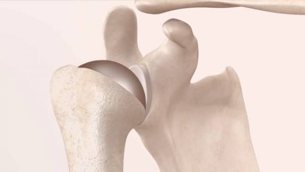 Primary Shoulder Replacement Patient Animation