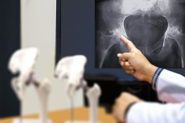 Hip Replacement Surgery. Doctors office xray of arthritic hip and patient hip joint models