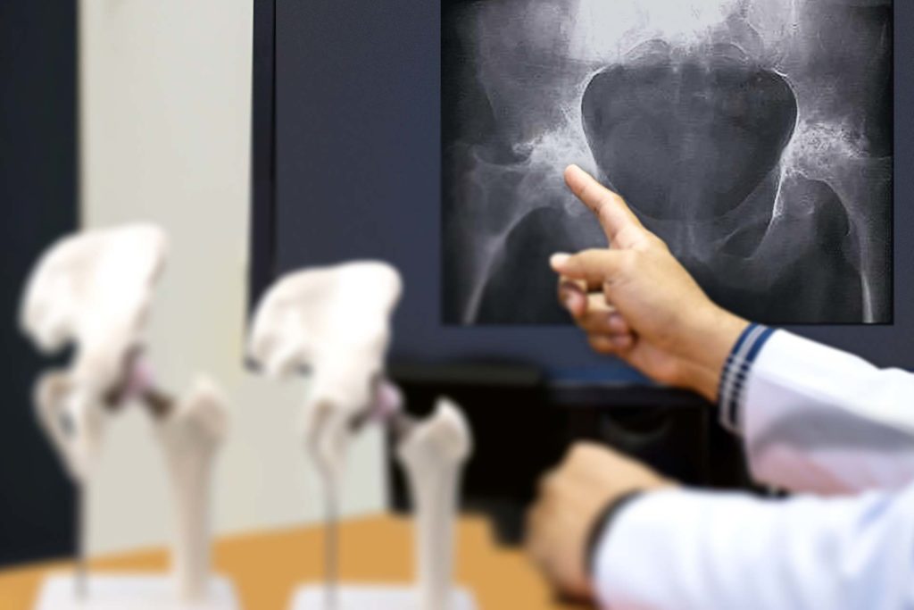 Hip Replacement Surgery Surgical Treatment Options Exactech