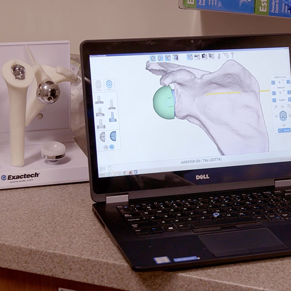 ExactechGPS helps surgeons plan for your surgery using a virtual simulation on a computer.