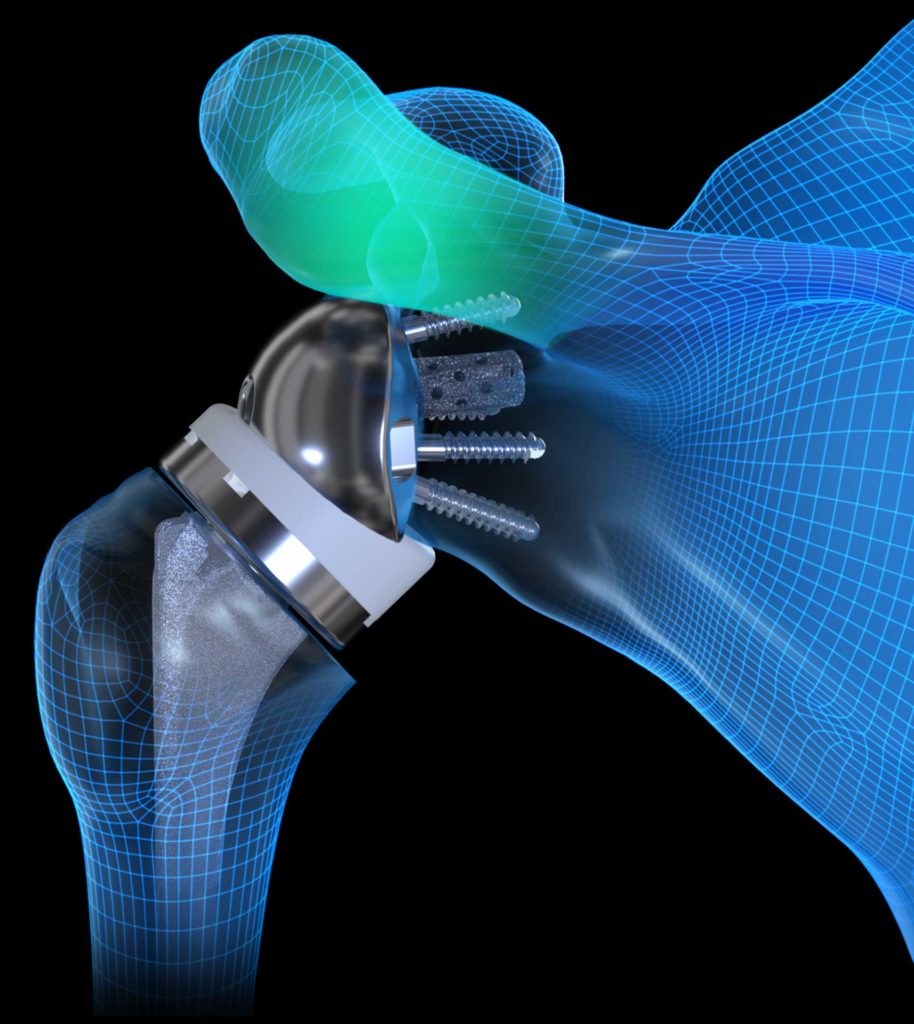 Exactech Equinoxe Fracture