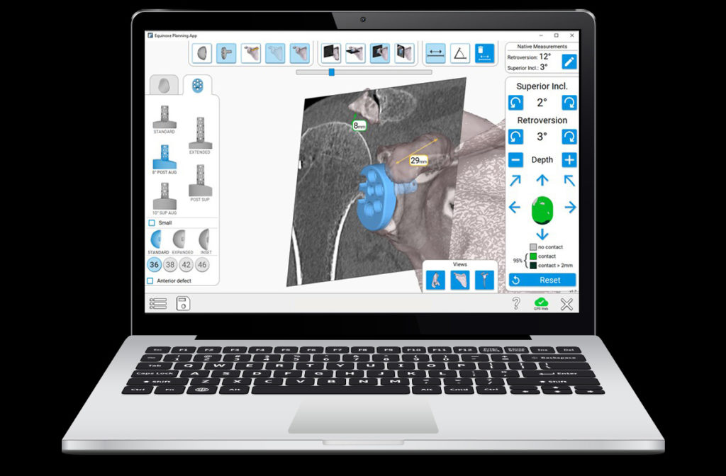 ExactechGPS Shoulder