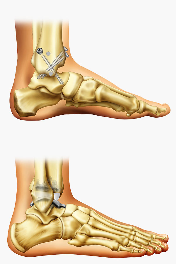 Vantage Total Ankle Replacement and Ankle Fusion