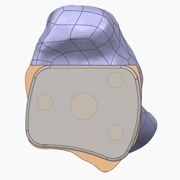 Exactech Vantage Ankle Design