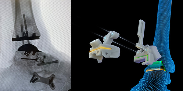 Vantage Ankle PSI Xray and Illustration of Instruments