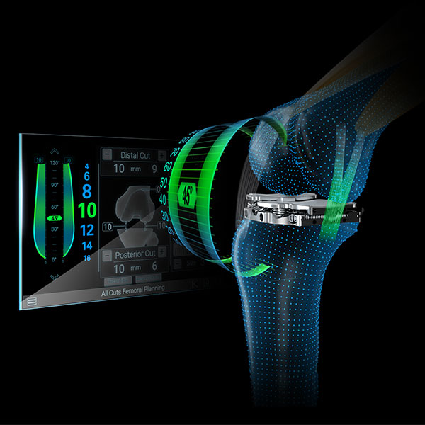 Newton Dynamic Knee Soft Tissue Management Technology
