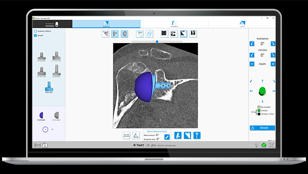 Equinoxe Shoulder Planning App