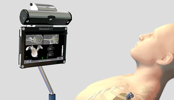GPS Shoulder Application Touchscreen tablet integrates seamlessly into the sterile field for easy access