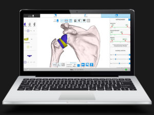 Equinoxe Shoulder Preoperative Planning App