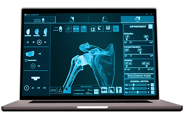 Exactech Equinoxe Shoulder Planning App