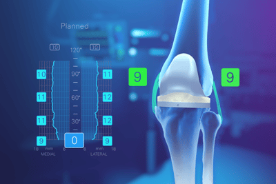 Exactech Knee