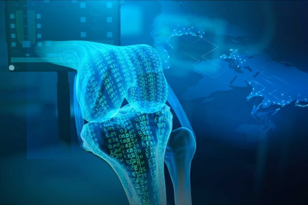 Exactech Accelerates International Expansion of Its Newton™ Balanced Knee Technology