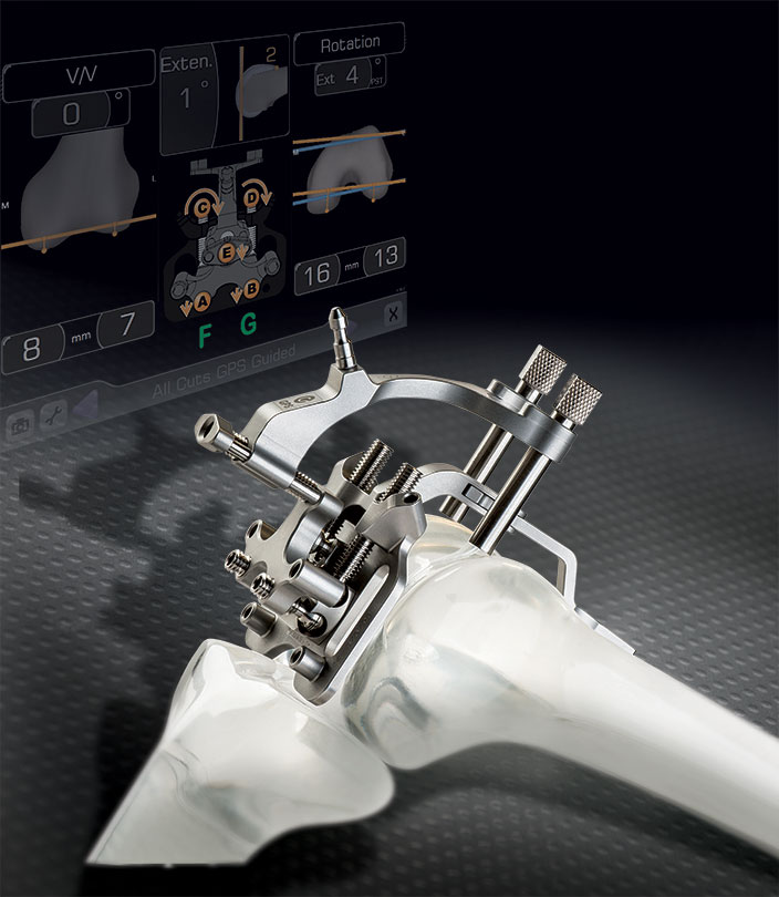 image of ExactechGPS in background with rendering of knee being operated on using ExactechGPS for Knee