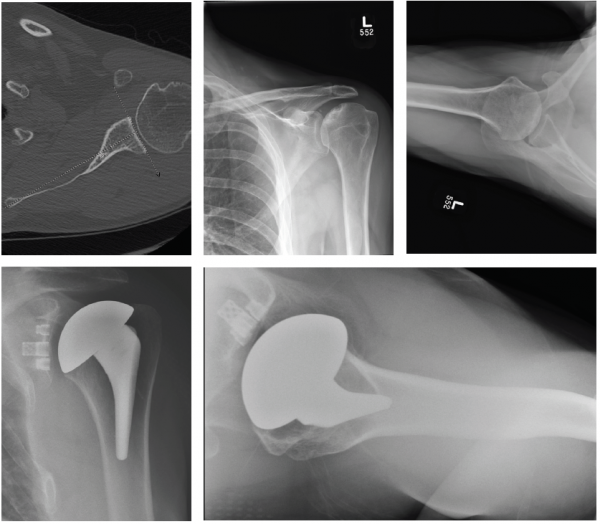 Patient 1: 59-year-old male with avascular necrosis of the humeral head. Left primary anatomic total shoulder arthroplasty using Equinoxe Preserve short stem and cage glenoid.