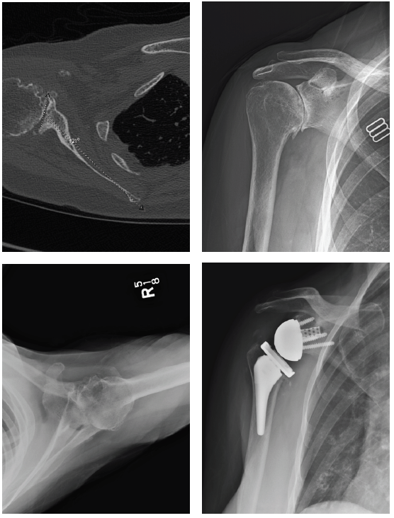 Patient 3: 74-year-old female with cuff tear arthropathy. Right primary reverse shoulder arthroplasty with augmented baseplate to treat glenoid wear.