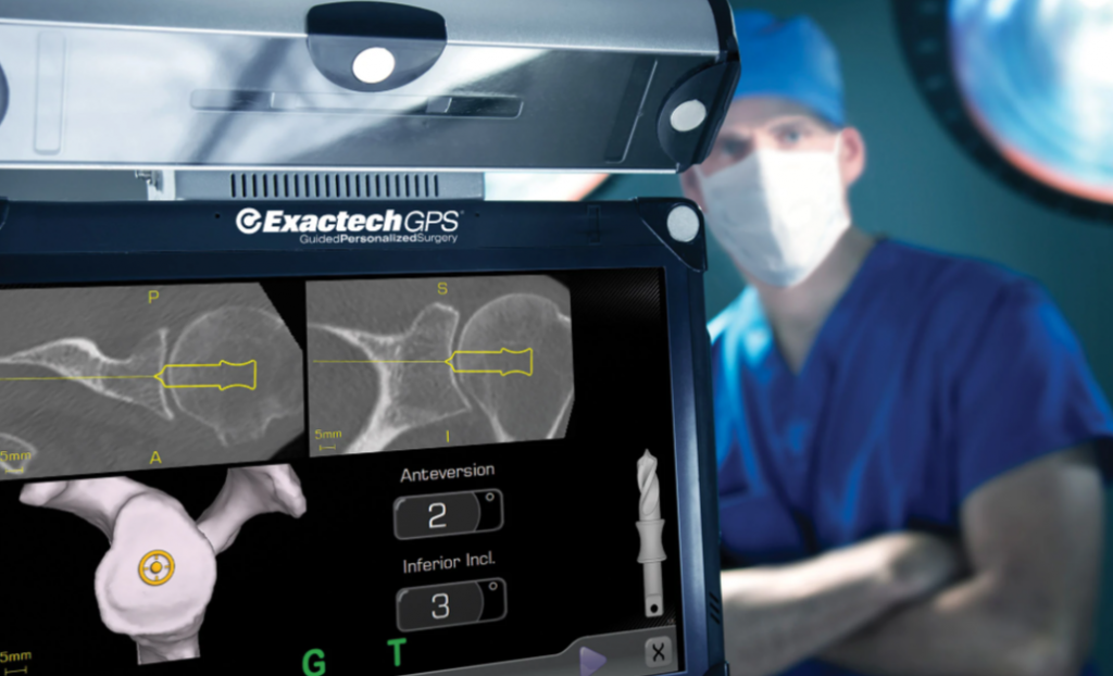 Using ExactechGPS to Help with Accurate Glenoid Placement