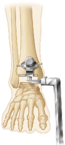 Figure 2. Recent trends in TAA technique favor not violating the anterior tibial cortex.