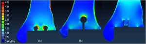 Figure 4. Finite element modeling suggests that vertically oriented pegs provide ideal loading characteristics on the tibial bone-implant interface.