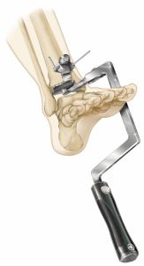 Figure 6. The instrumentation to prepare the tibia for vertical peg and cage orientation is unique and simple to use.