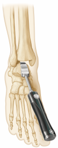 Figure 7. A simple manual rasp is used to complete the uniform talar dome preparation.