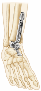 Figure 9. Talar preparation is uncomplicated, with reproducible positioning of the talar component in both the coronal and sagittal planes.