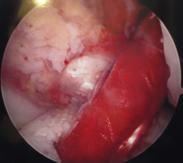 Figure 1. Intraoperative arthroscopic photograph of a left knee from a standard anterolateral viewing portal demonstrating final anterior cruciate ligament graft placement. An overlying porous collagen carrier has been sutured to circumferentially cover the hamstring autograft, and platelet rich plasma has been injected into the graft.