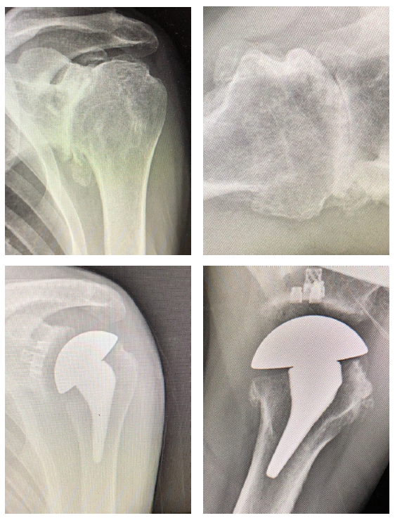 Patient 1: Primary anatomic total shoulder arthroplasty using Equinoxe Preserve short stem and caged glenoid.