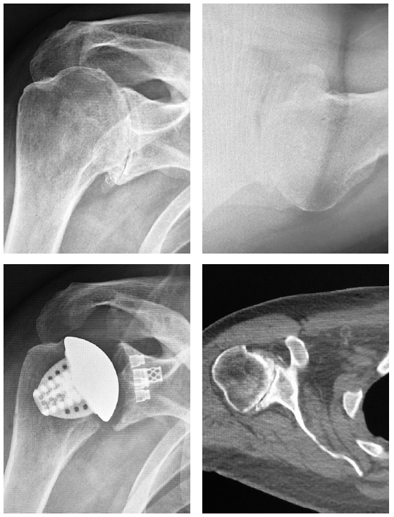 Patient 2: Primary anatomic total shoulder arthroplasty using a stemless implant.