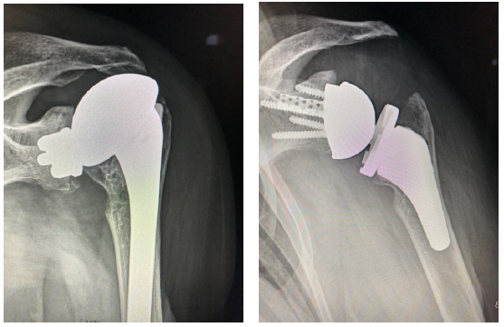 Patient 3: Revision of a failed anatomic total shoulder with loose humeral stem to reverse total shoulder arthroplasty