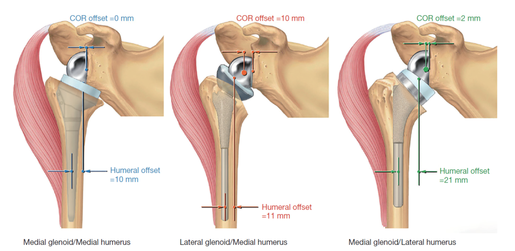 Reverse Shoulder Biomechanics and Scapular Notching Shoulder Illustration