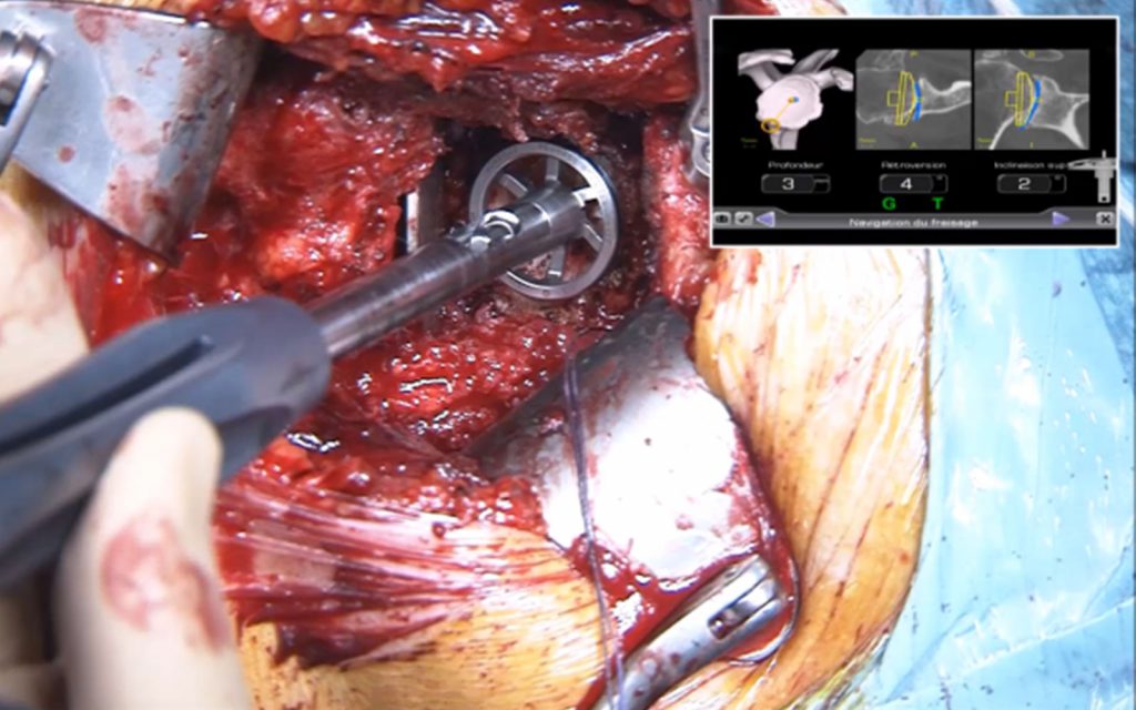 ExactechGPS and Equinoxe Shoulder Navigation Surgery