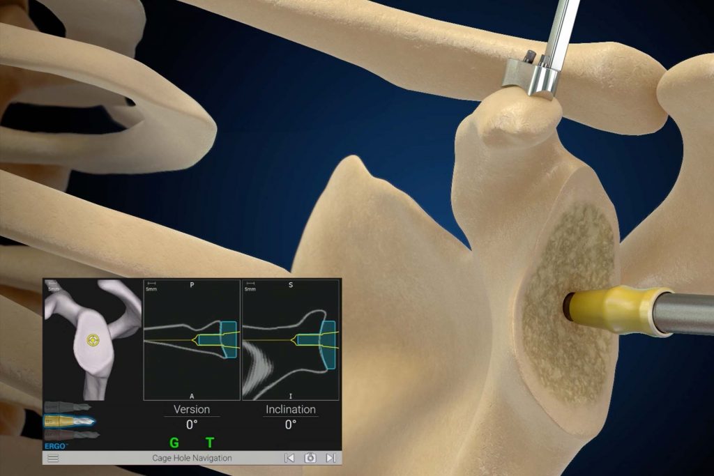Exactech GPS Shoulder