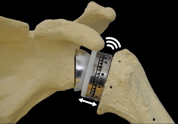 Exactech Partners with Statera Medical to Co-Develop World’s First Smart Reverse Shoulder