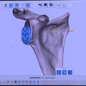 Equinoxe Planning App Surgical Demo with Dr. Sajadi